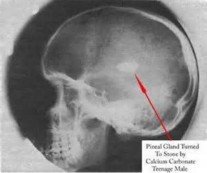 gland pineal fluoride calcified neurotoxin awaken calcification calcium impairing kundalini